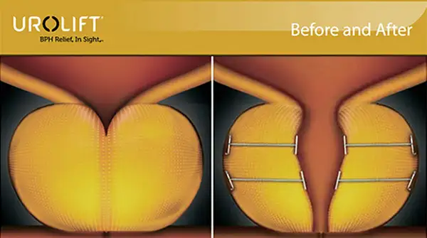 What is UroLift®?